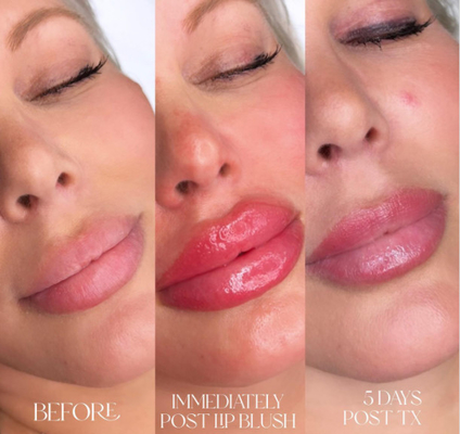 Skinject Füller der tiefe Hyaluronsäure-Haut-Lippen2ml injizierbar