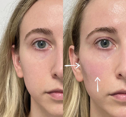 Skinject Füller der tiefe Hyaluronsäure-Haut-Lippen2ml injizierbar