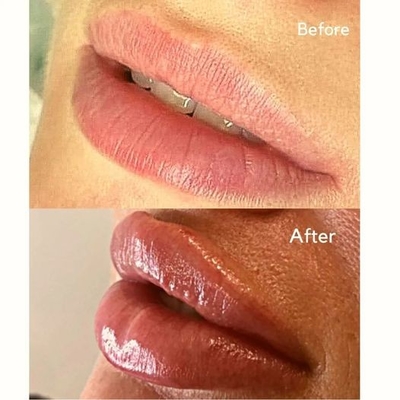 Injizierbare Füller-Einspritzung Juvederms Hautfüller von ultra 3 ha für Lippenvolumen