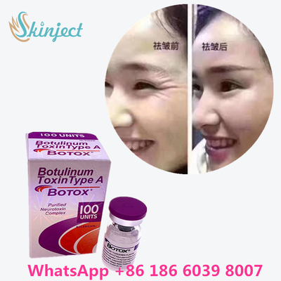 Botulinumgiftstoff  knittern Abbau 100u Allergan 100 Einheiten für Facelift-Einspritzung