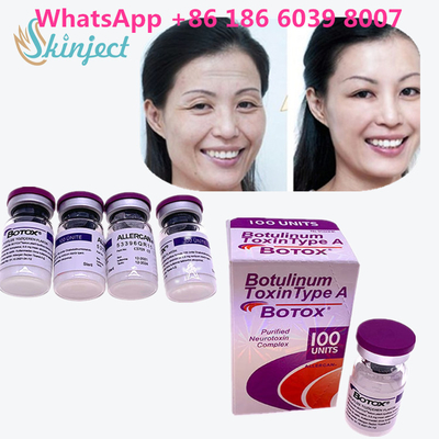 Botulinumgiftstoff  knittern Abbau 100u Allergan 100 Einheiten für Facelift-Einspritzung