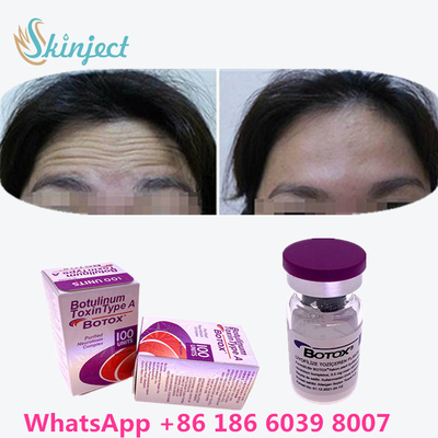 Botulinumgiftstoff  knittern Abbau 100u Allergan 100 Einheiten für Facelift-Einspritzung