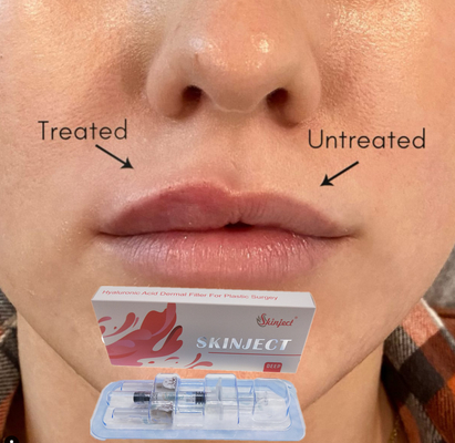 Füller-Backe Chin Nasolabial Fold der injizierbare tiefe Hyaluronsäure-Haut-Lippen2ml