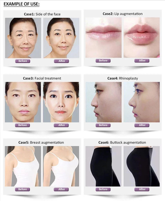 tiefer Hyaluronic Hautfüller 1.1ml Revolax für Gesicht