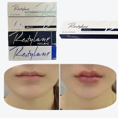 Cross-Linked Hyaluronsäure Hautfüllmittel zur Brustlippenvergrößerung