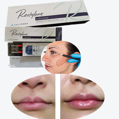 Cross-Linked Hyaluronsäure Hautfüllmittel zur Brustlippenvergrößerung