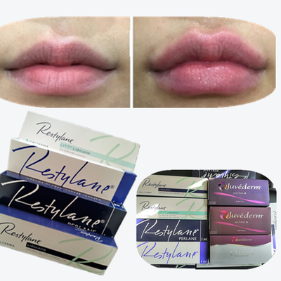 2*1ml/Box Hyaluronsäure Hautfüllmittel zur Lippenvergrößerung