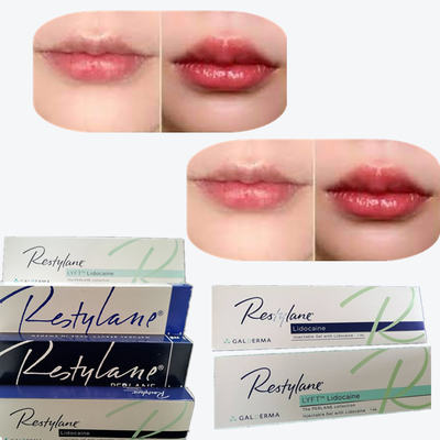 2*1ml/Box Hyaluronsäure Hautfüllmittel zur Lippenvergrößerung