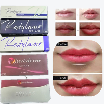 2*1ml/Box Hyaluronsäure Hautfüllmittel zur Lippenvergrößerung