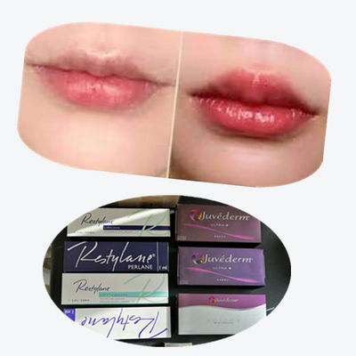 2*1ml/Box Kreuzverknüpfte Hautfüllmittel zur Lippenvergrößerung