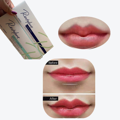 2*1ml/Box Kreuzverknüpfte Hautfüllmittel zur Lippenvergrößerung