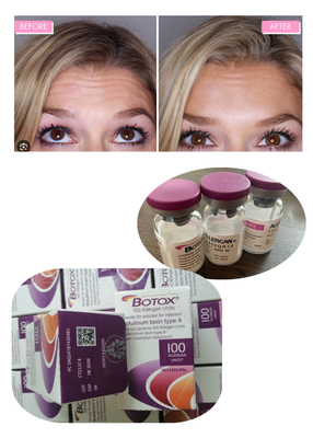 Anti-Falten Botulinum Toxin Allergan 100IU 150iu  Injektionen ' Na