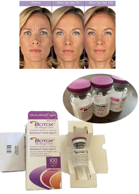 gegen Falten Botulinum Toxin Allergan 100IU 150iu ' Na