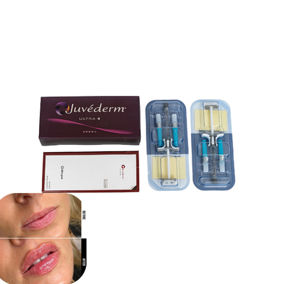 Juvederm Hautfiller für Lippen Injektionsfiller mit Hyaluronsäure