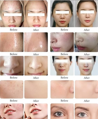Neue Einführung Schwarze Perle 10 in 1 Hydra Peeling Maschine Mikrodermabrasion Maschine Gesichts Spa Mikrotouch Hydra Hautpflege