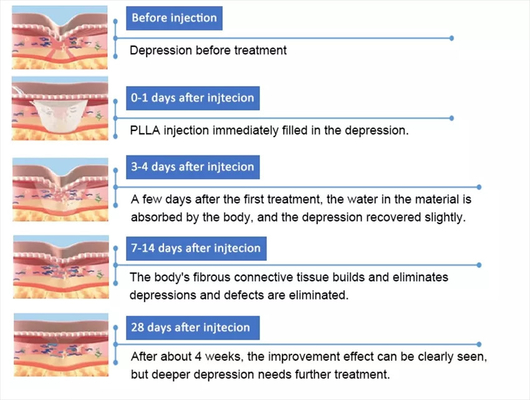 PLLA Poly-L-Milchsäure Gesichtsinjektion 10 Durchstechflaschen 150 mg