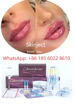 Gesichtshyaluronsäure-Hautfüller Juvederm