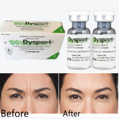 Botulinumtoxin Dysport Antiwrinkle Pulver Gefriertrocknetes Pulver für Glabellare Linien