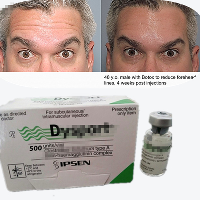 Botulinumtoxin Dysport Antiwrinkle Pulver Gefriertrocknetes Pulver für Glabellare Linien