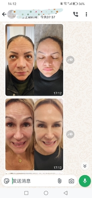 Kosmetische Dysport 500 Einheiten Botulinumtoxin 500 IE Pulver zur Injektion