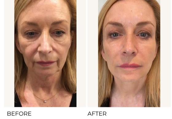 Anti-Aging und Faltenentfernung Profhilo H L 2 ml Hyaluronsäure mit einer Konzentration von 32 mg/ml Ha
