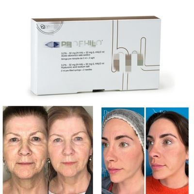 Natürlich aussehendes Lifting 5-Punkt-Lifting-Nadel Profhilo Injektionsfähiger Dermal Filler