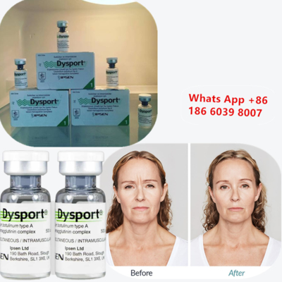 Botulinumtoxin Typ A-Dysport-Injektion zur Faltereduzierung