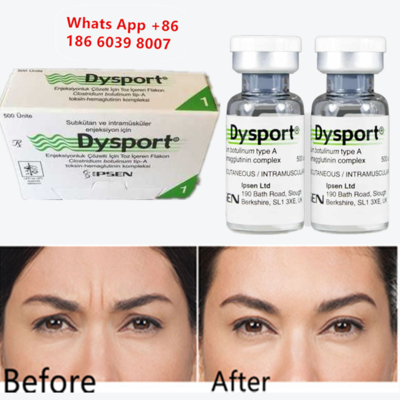 Botulinumtoxin Typ A-Dysport-Injektion zur Faltereduzierung
