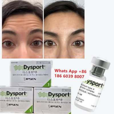Dysport-Botulinoxin Typ A für Fräulein- und Glabellinien