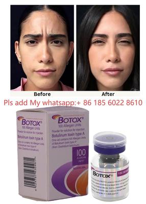 Botulinumtoxin Allergan Botox 100IE Injektion - Reduzieren Sie Alterserscheinungen mit Allergan
