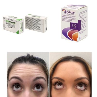 100 Einheiten Korea BTX Botulinumtoxin gegen Falten und feine Linien