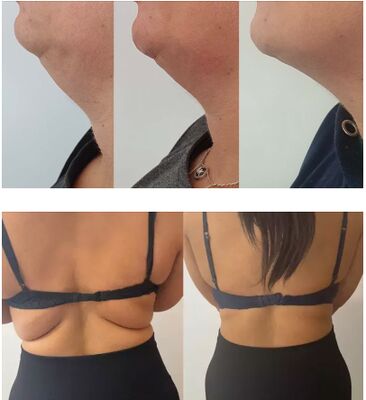 Zitronenflasche Fettlösungsinjektionen Lipolytische Lösung