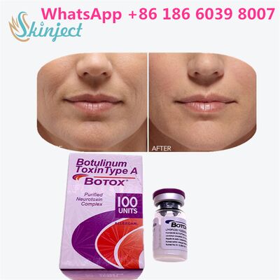 Botulinumtoxin ALLERGAN BOTOX Dauer 4 bis 6 Monate 100 Einheiten Typ A