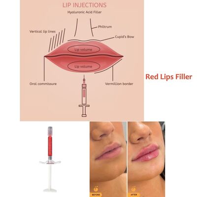 Individuelle Anpassung 1ml 24mg/Ml Rote Lippenfüller-Injektion Lippeninjektionen