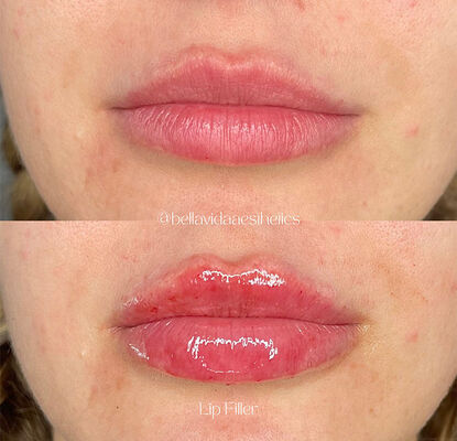 Haltbarkeit 2 Jahre Dermalfiller injizierbares Gel zur Faltereduzierung, Gesichtskontur und Hautrevitalisierung