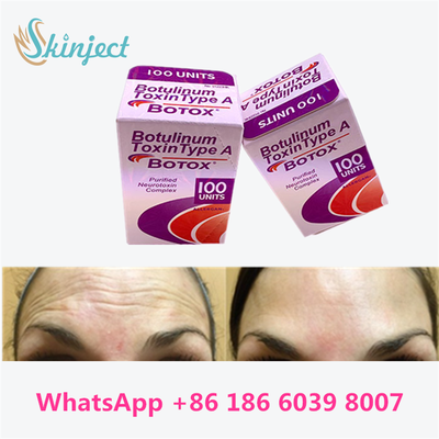 Botulinumtoxin Allergan BOTOX Kosmetische Injektion 100 Einheiten für Glabellare Linien