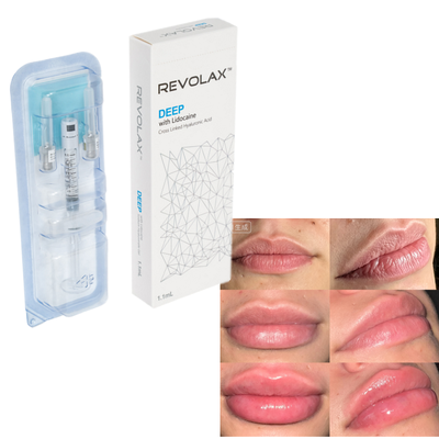 Revolax Hyaluronsäure Hautfüllmittel Natürliche Fettfülle Lippenvergrößerung Gesichtsvolumenwiederherstellung