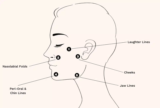 Profhilo Behandlung Hyaluronsäure Skin Booster & Bio-Remodelling