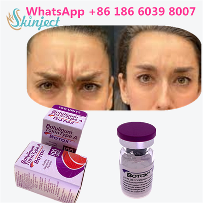 Botulinumtoxin BOTOX Kosmetik 100 Einheiten Allergan OnabotulinumtoxinA für Gesichtsfalten
