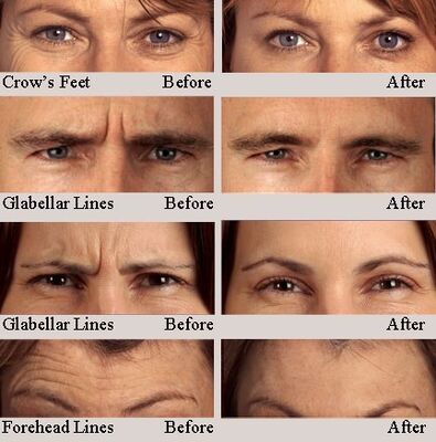 Hyamely Premium Botulinum Toxin Typ A für die Injektion