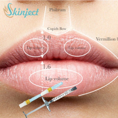 Volle Lippenbacken-injizierbarer Hautfüller-Hyaluronsäure ha-Füller 1ml 2ml 5ml