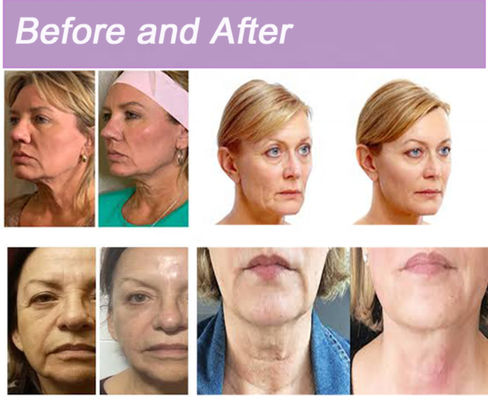Alterndes PDO-Antikollagen verlegt Face lifting Polidioxanona Sutura