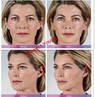 Hyaluronsäure-injizierbare Gel-Füller Juvederm Voluma 2x1ml