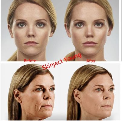 Hyaluronsäure-injizierbare Gel-Füller Juvederm Voluma 2x1ml