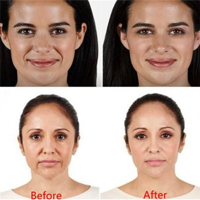 Hyaluronsäure-Pen Filler For Forehead Eyes-Falten Juvaderm Voluma