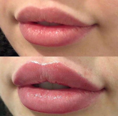 Russische Lippen Juvederm ultra 3 mit -Kreuz verbundenem Hautfüller