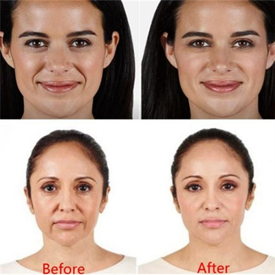 FÜLLER-Lippeneinspritzungen ha 2ml knittern Hautfüller injizierbares Juvederm