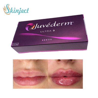 Lippenfüller Juvederm Ultra3 der Hyaluronsäure-281ML Haut