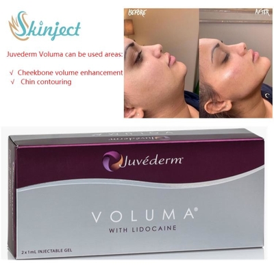 Hyaluronsäure-Hautfüller Juvederm Voluma 2x1ml für Wangenknochen