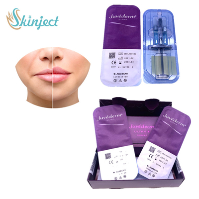 Lippenerweiterungs-Hautfüller-Hyaluronsäure Juvederm Ultra4